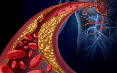 Enfermedades Cardiovasculares